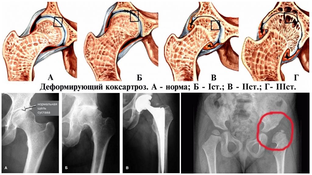 Коксартроз Тазобедренного Сустава: Что это и как с этим жить?